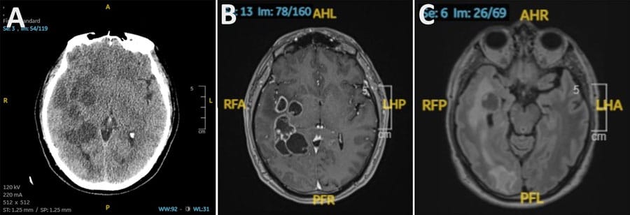 MRI brain scan showing encapsulated Taenia solium larvae, with the worms' heads (scolexes) visible inside the lesions
